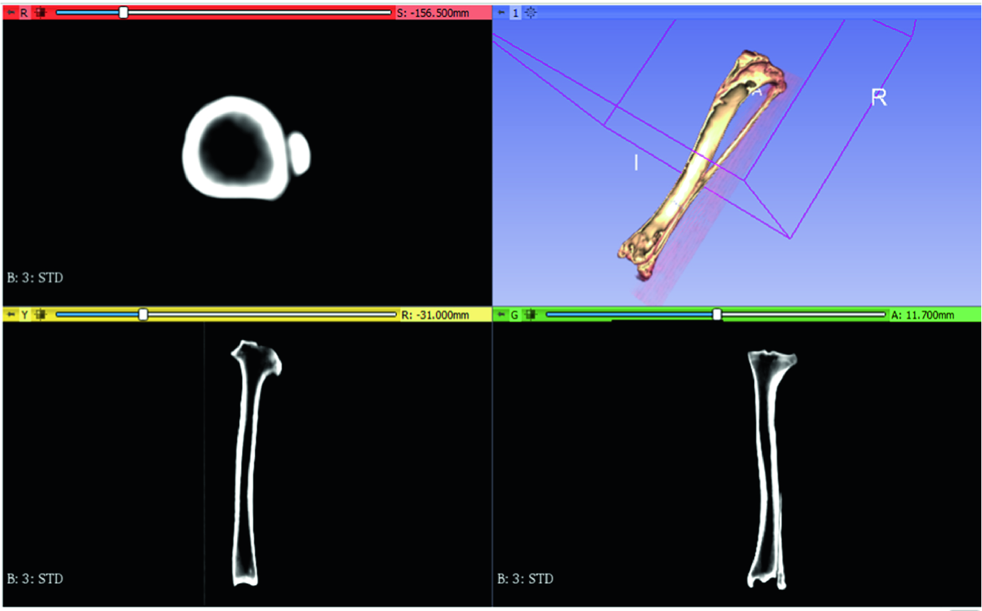 Tibia