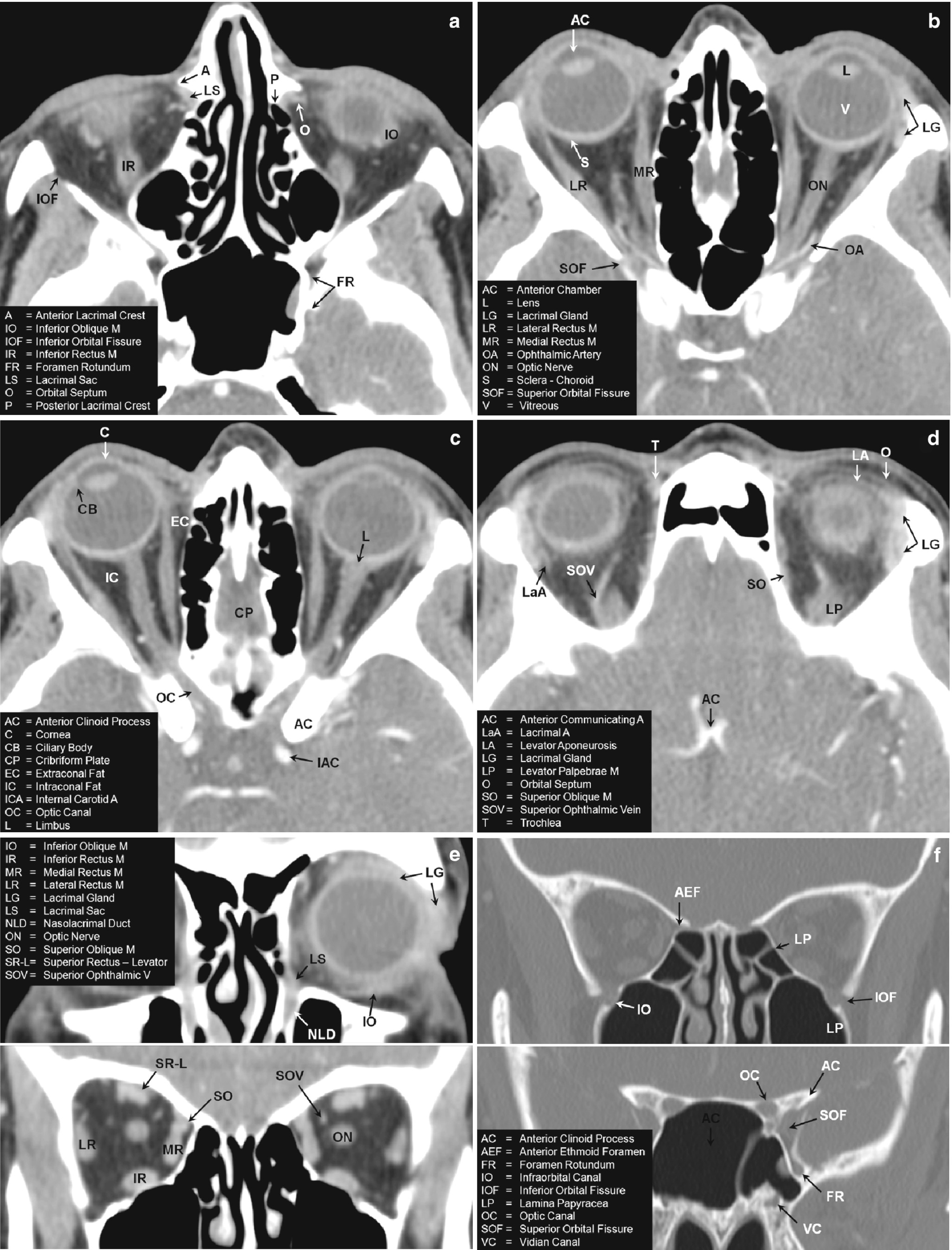 Orbital Radiology Springerlink
