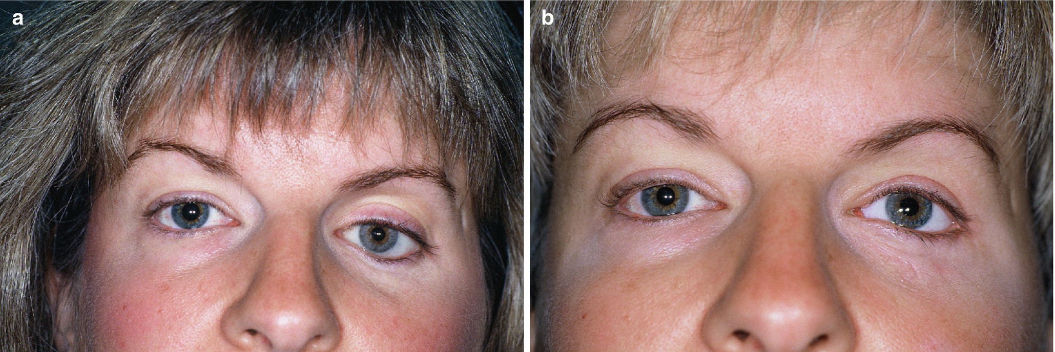 private eyelid cyst surgery cost
