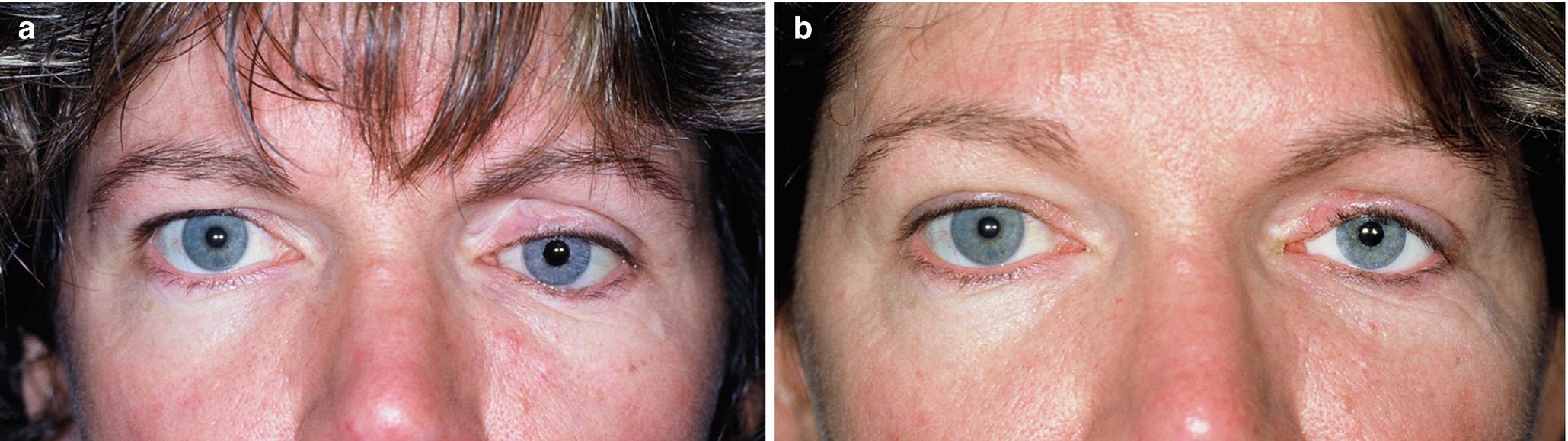 evaluation and management of the anophthalmic socket and socket reconstruction springerlink