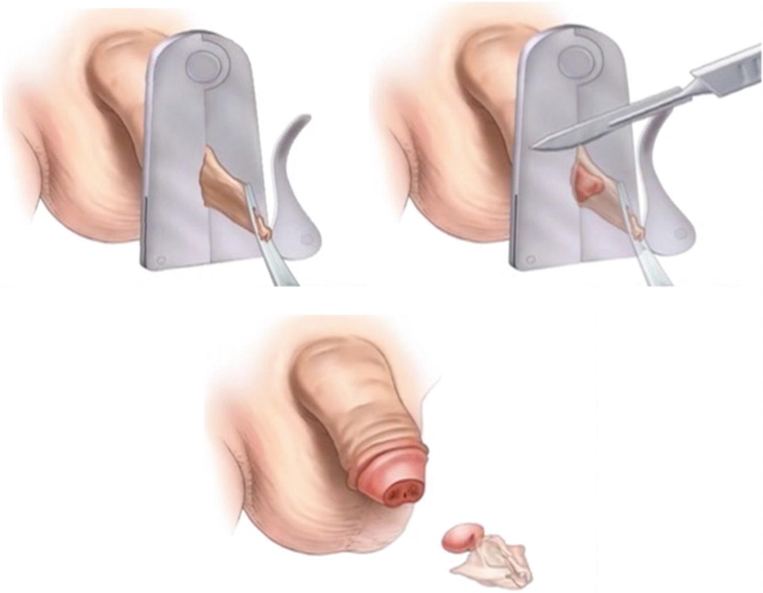 Male Circumcision Springerlink