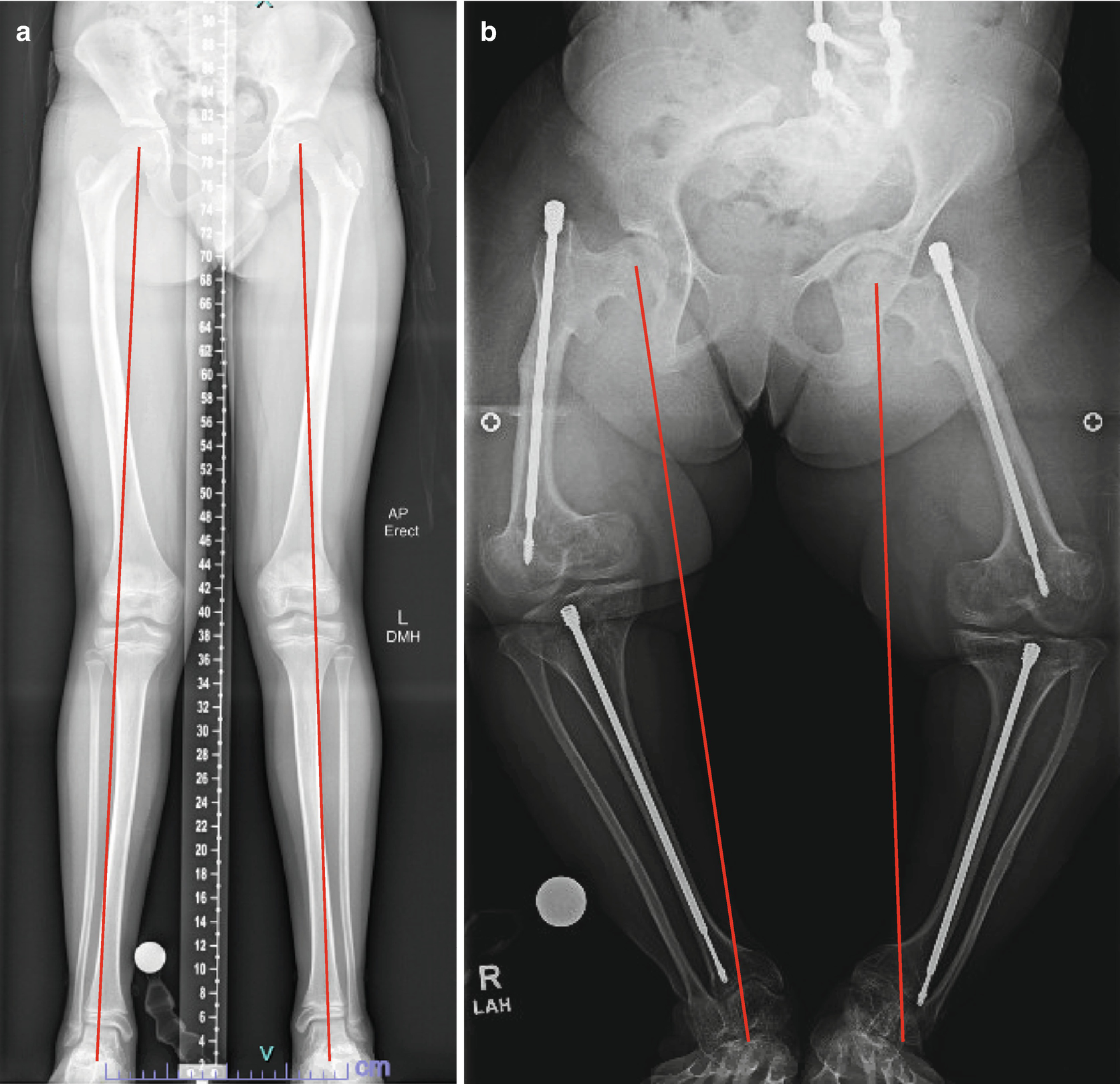 The surgical fracture of a bone to correct a deformity