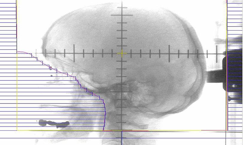 Role Of Whole Brain Radiotherapy Springerlink