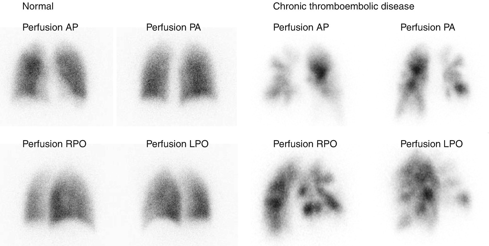 Functional Assessment Of Pulmonary Venous Thromboembolism Springerlink