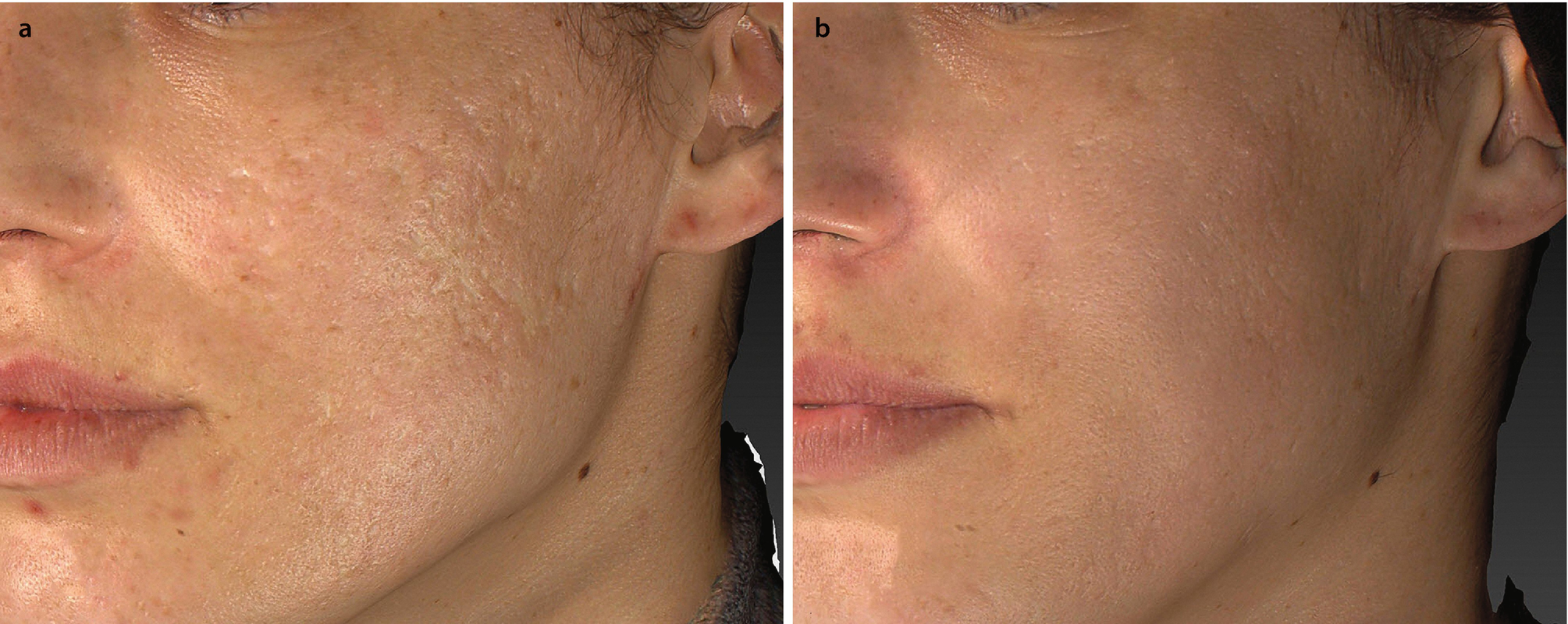 best treatment for atrophic scars