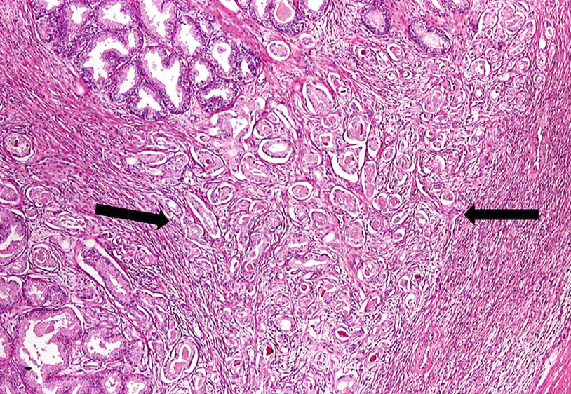 Papillary urothelial neoplasm tumors,, A papillary urothelial neoplasm