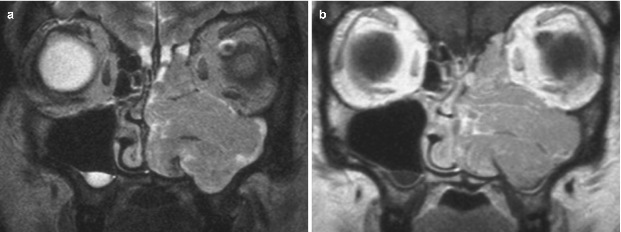 Nasal papilloma mri. Inverted papilloma nasal mri, Frontal sinus osteoma – case report