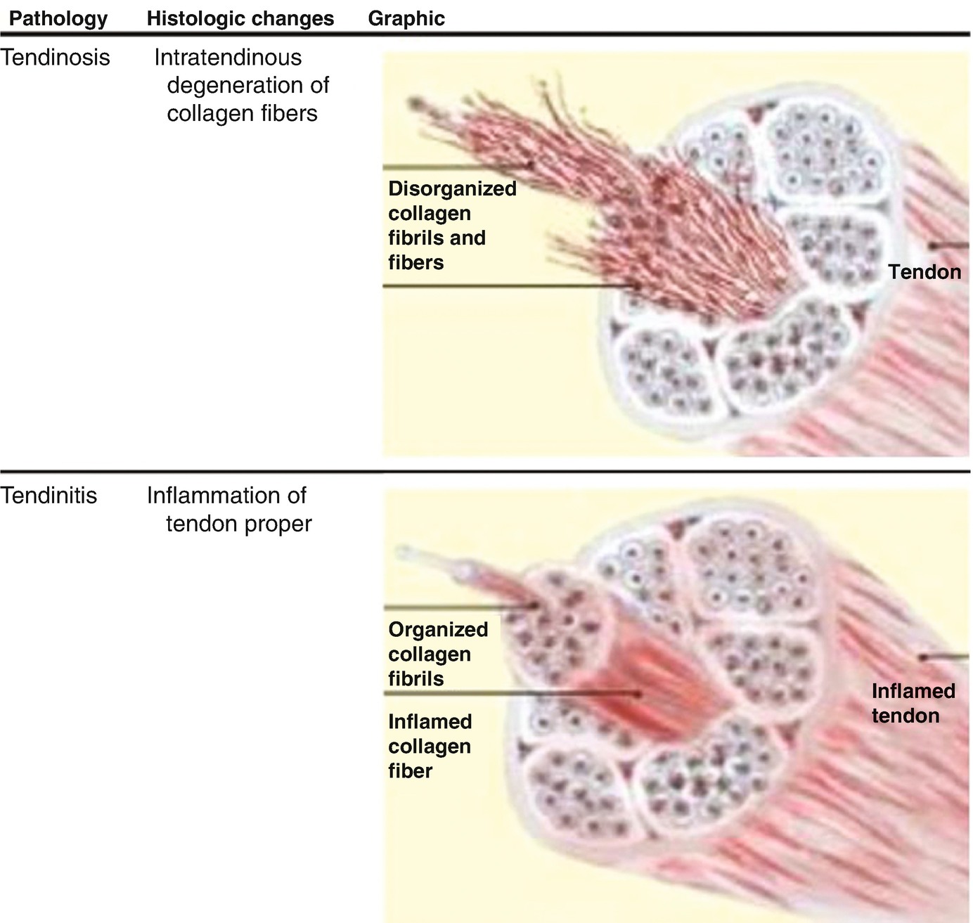Peroneal Tendonitis And Tendonopathy Springerlink