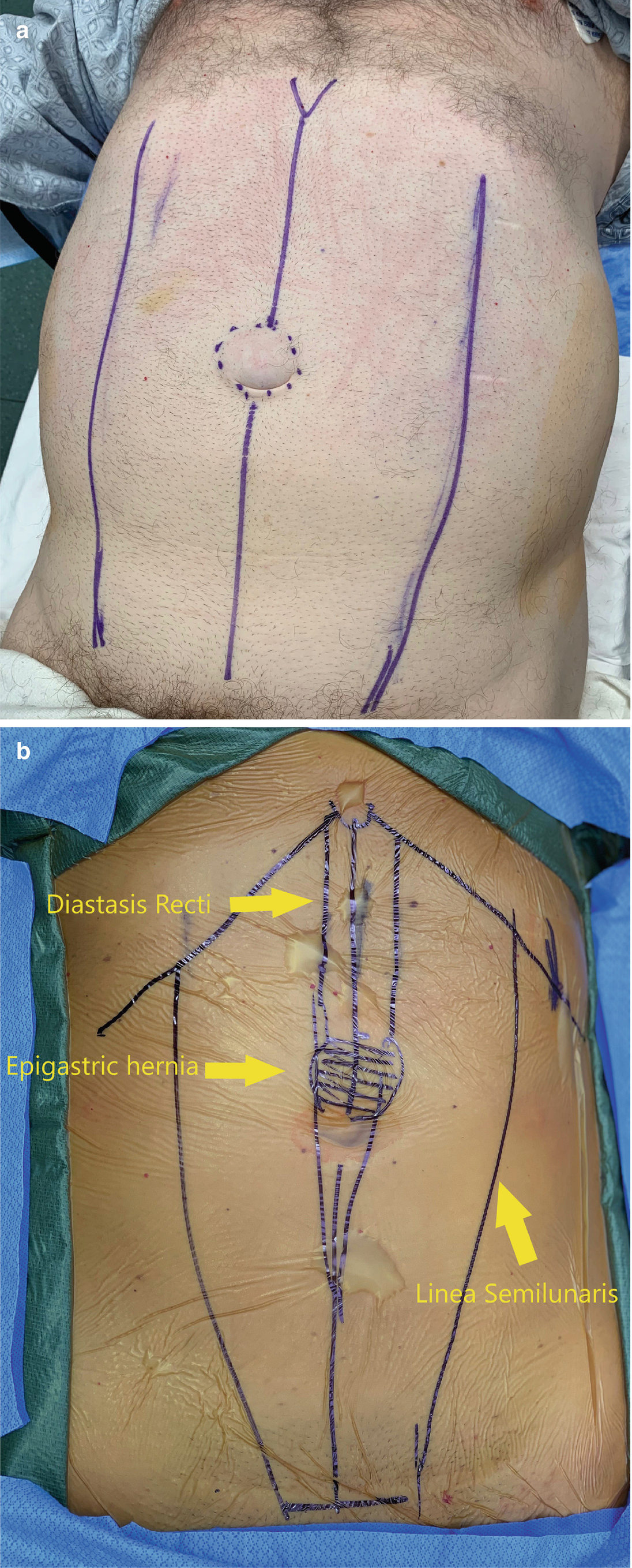 Robotic Epigastric Hernia Repair Totally Extraperitoneal Tep Springerlink