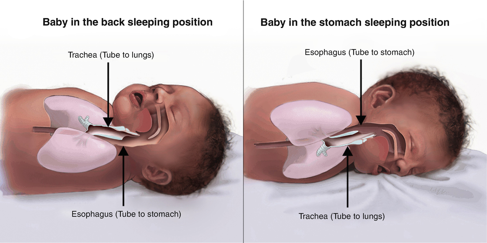 Supine Back Sleep Position Springerlink