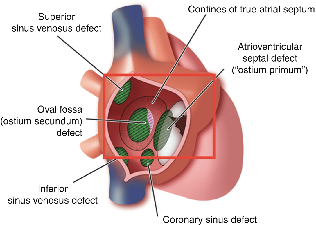 Commonly Encountered Congenital Heart Disease Springerlink