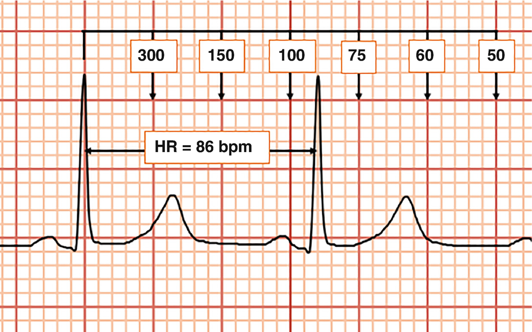 Approach To Ecg Interpretation Springerlink