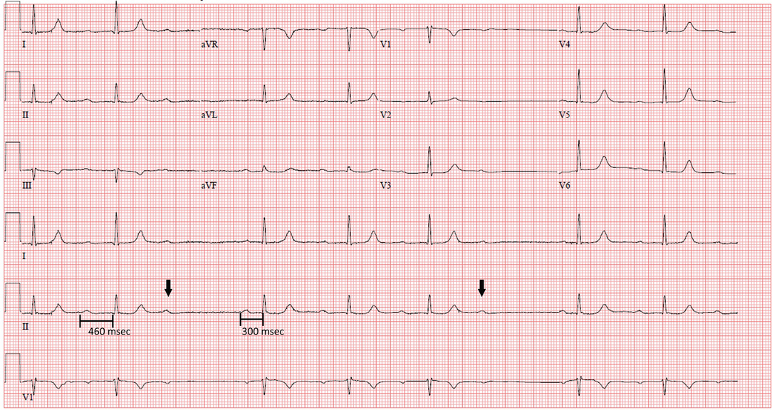 Bradyarrhythmias And Av Block Springerlink Bradyarrhythmias And Av Block Springerlink