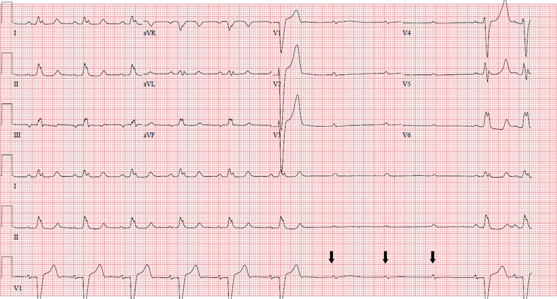 Bradyarrhythmias And Av Block Springerlink Bradyarrhythmias And Av Block Springerlink