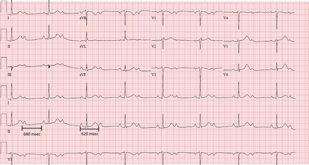 Bradyarrhythmias And Av Block Springerlink