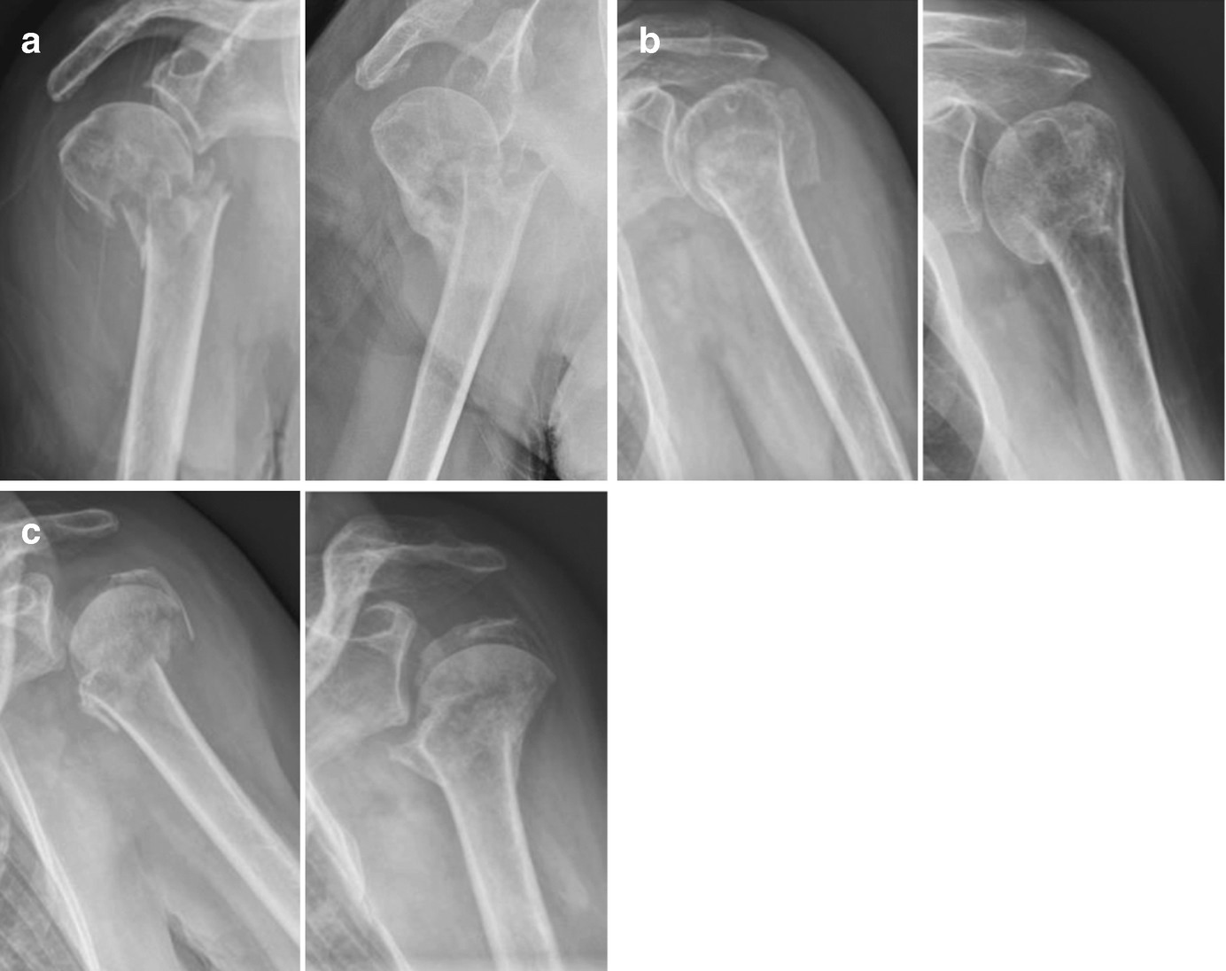 Proximal Humeral Fractures The Choice Of Treatment Springerlink