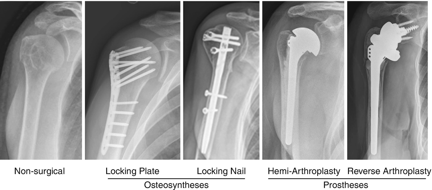 Proximal Humeral Fractures The Choice Of Treatment Springerlink