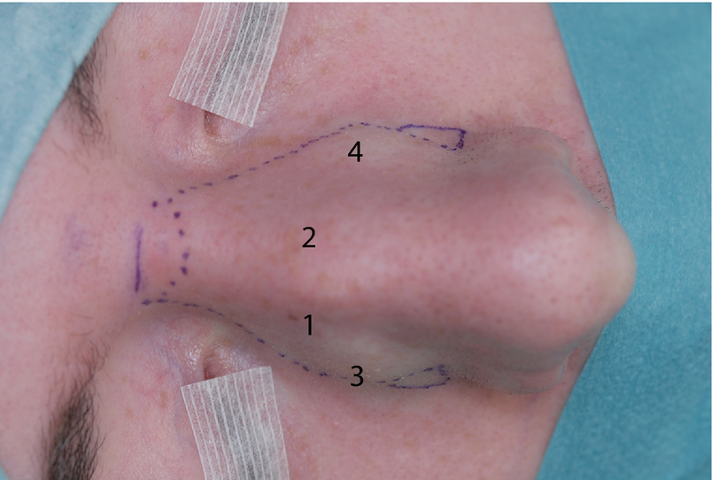 Controlling The Nasal Dorsum Springerlink