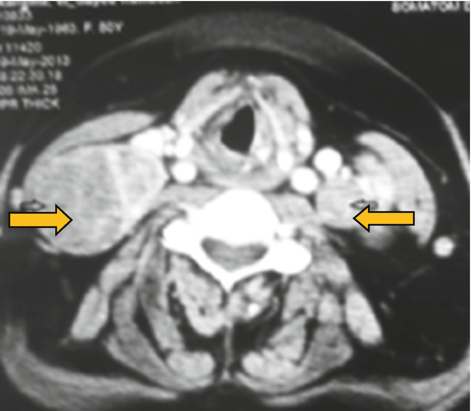Thyroid Cancer Springerlink