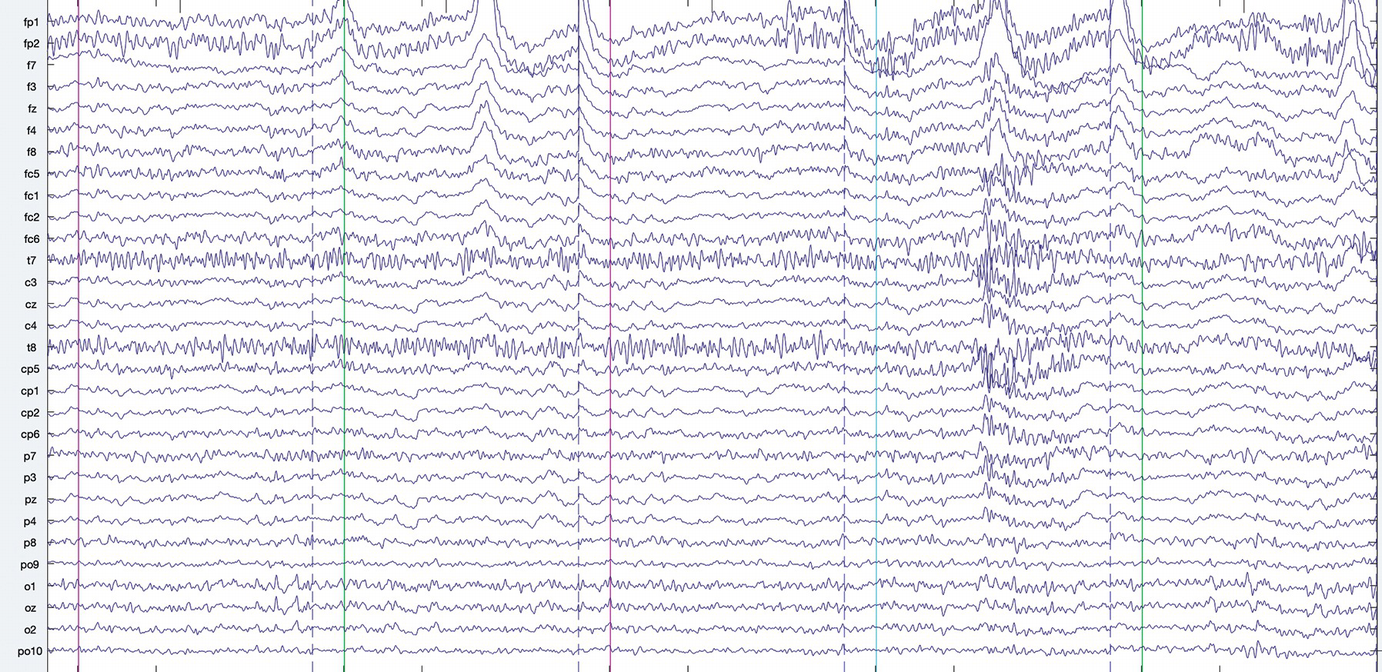 Electroencephalography And Childhood Trauma Springerlink