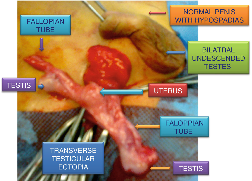 Persistent Mullerian Duct Syndrome Springerlink