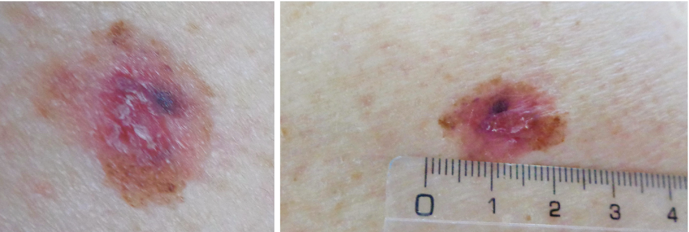 A 45 Year Old Woman With A Brown Spot On The Right Arm Springerlink