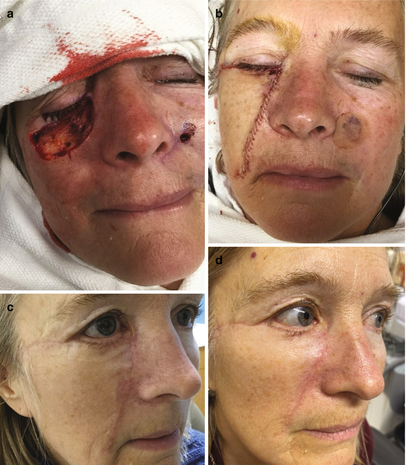 Periocular Scarring Springerlink