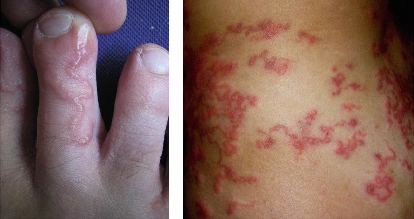 how to test for hookworms in humans how to test for hookworms in humans