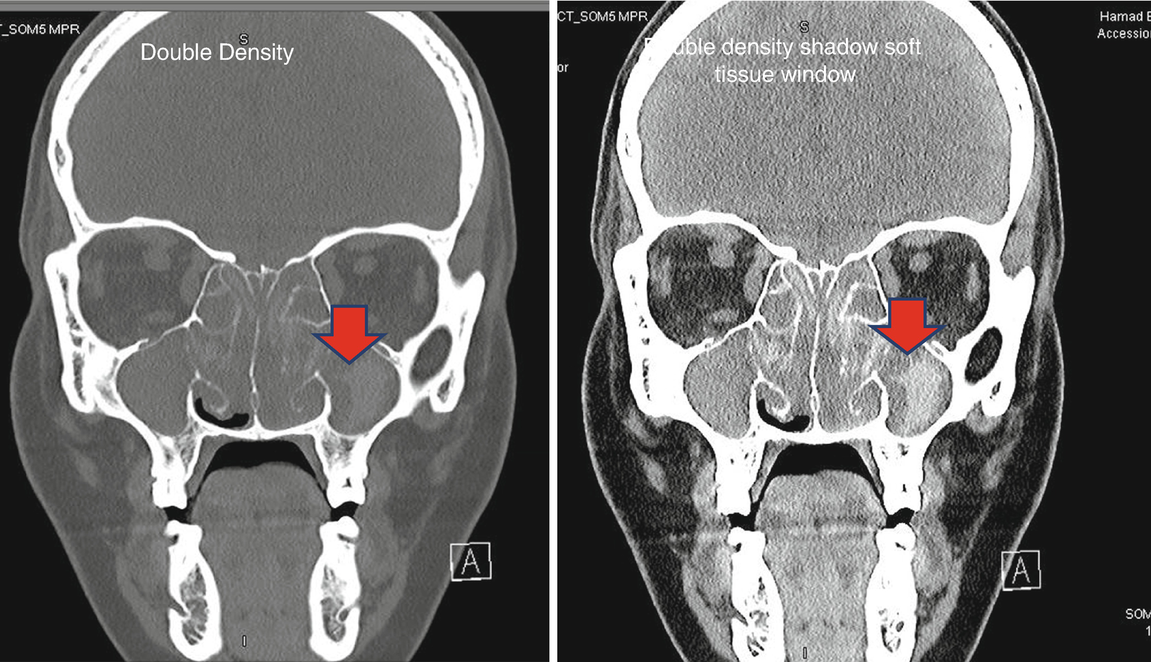 Radiology Of Paranasal Sinuses Springerlink Radiology Of Paranasal Sinuses Springerlink