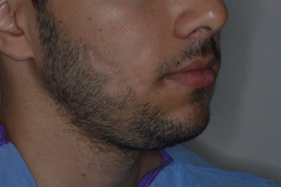 0.8 mm beard