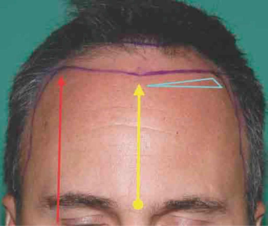 feathered hairline