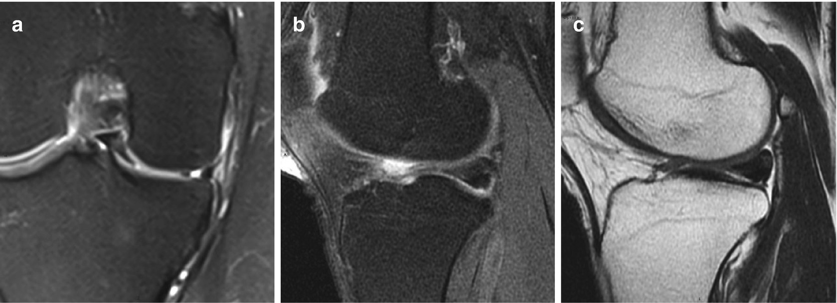 Ball And Socket Ankle Joint Radiology Case Radiopaedia Org