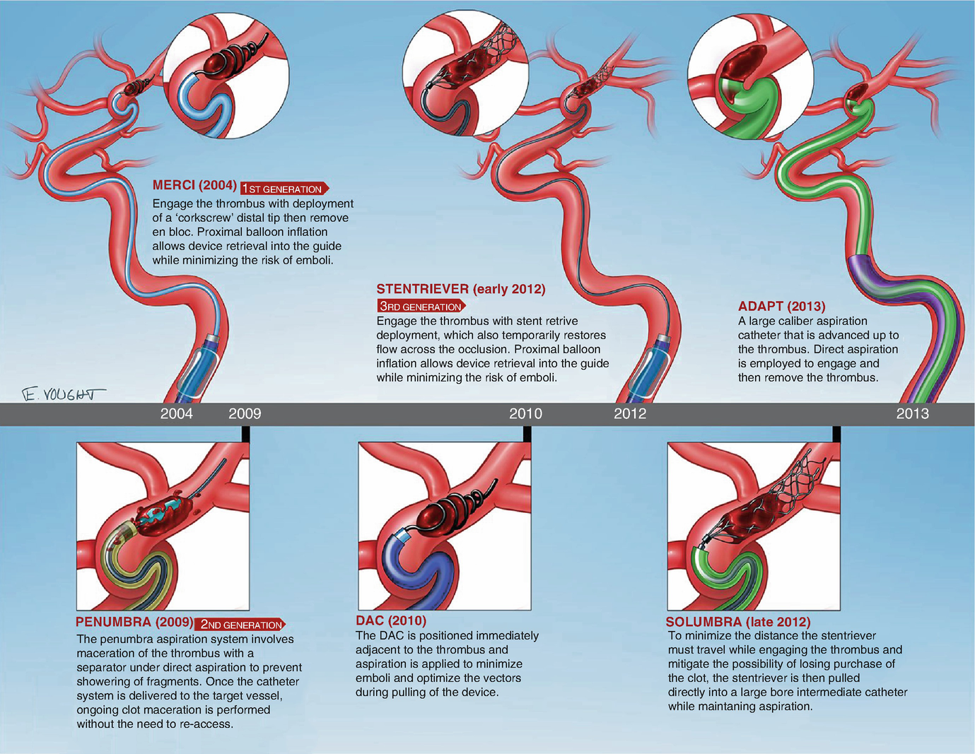 Direct Aspiration Thrombectomy For Acute Stroke Evolution Of Technique And Evidence Springerlink