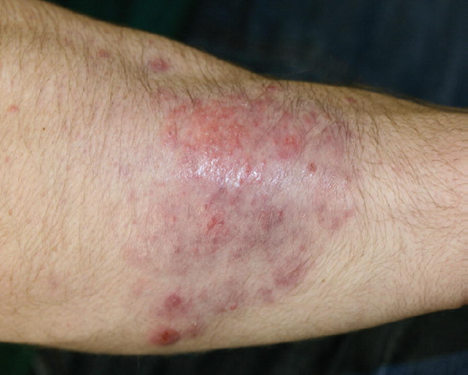 Fungal Infections Of The Skin Springerlink