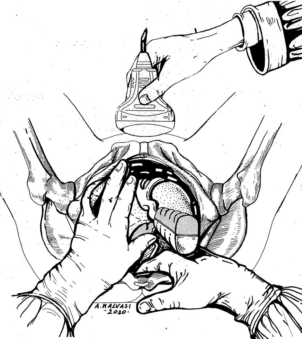 Intrapartum Sonography And Clinical Risk Management Springerlink