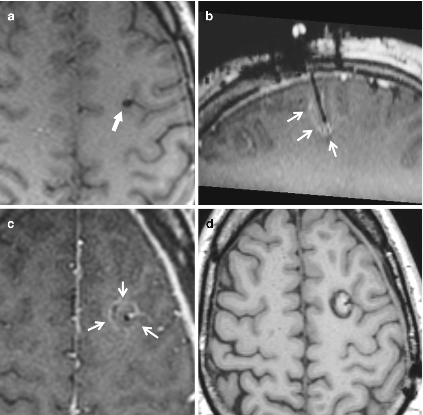 Neuroimaging And Epilepsy Springerlink