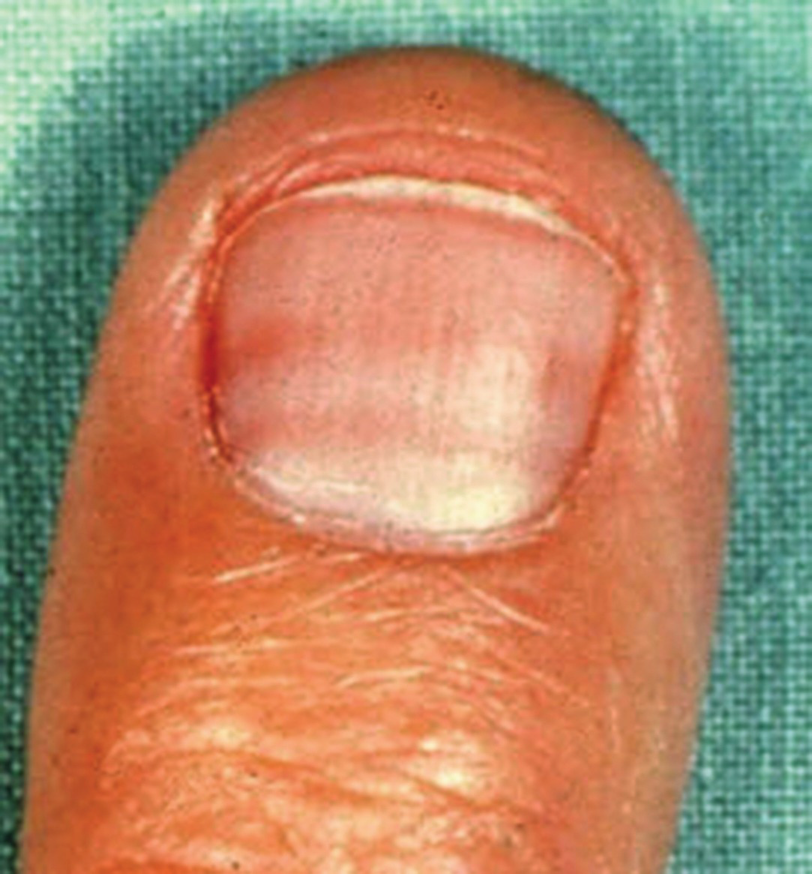Recent Advances In Nails In Systemic Disease Springerlink Recent Advances In Nails In Systemic Disease Springerlink