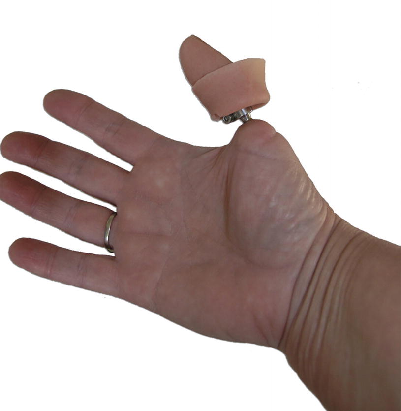 Osseointegrated Amputation Prostheses And Implanted Electrodes Springerlink