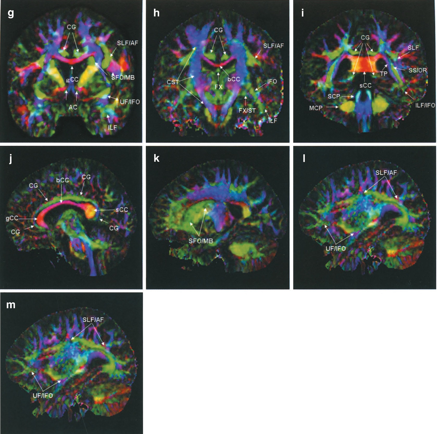 Diffusion Weighted And Tensor Imaging Of The Normal Brain Springerlink Diffusion Weighted And Tensor Imaging Of The Normal Brain Springerlink