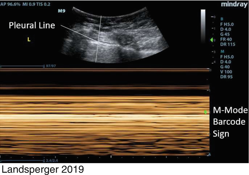 Extended Focused Assessment with Sonography in Trauma (eFAST) | SpringerLink