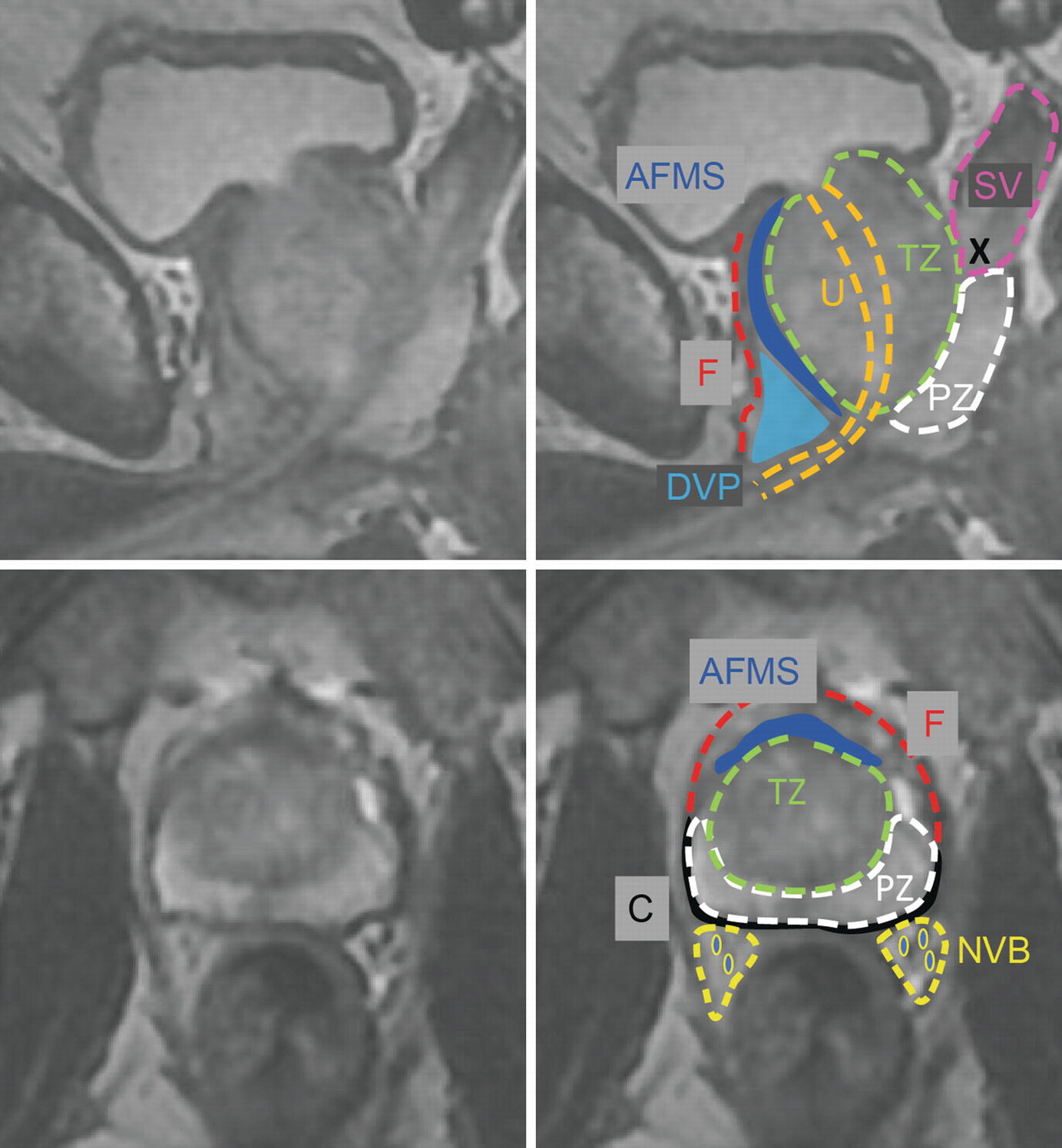 prostate zones anatomy mri