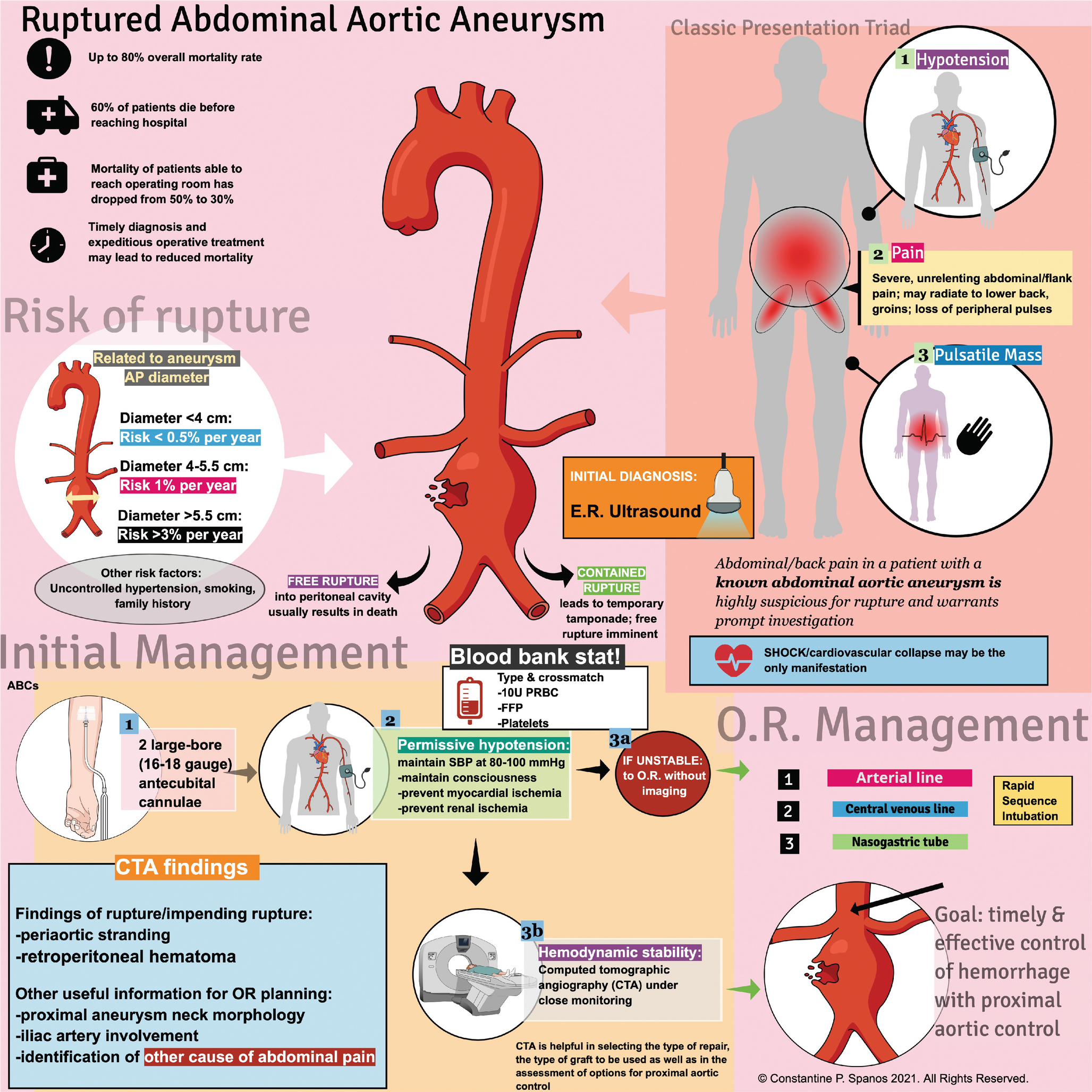 Ruptured Abdominal Aortic Aneurysm Springerlink Ruptured Abdominal Aortic Aneurysm Springerlink