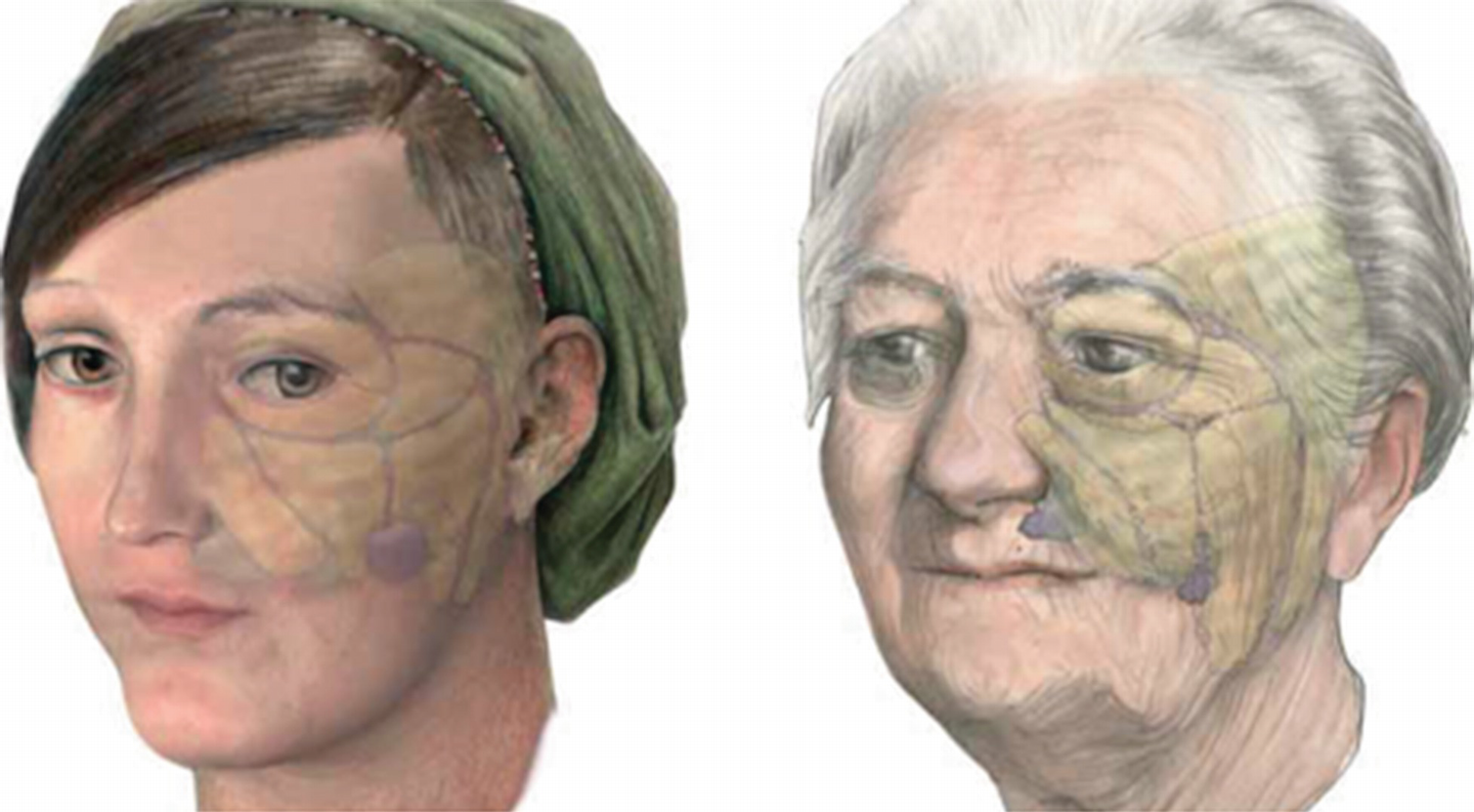 Что происходит с людьми с возрастом. Жировые пакеты лица старение. Анатомия старения лица. Жировые КОМПАРТМЕНТЫ лица.