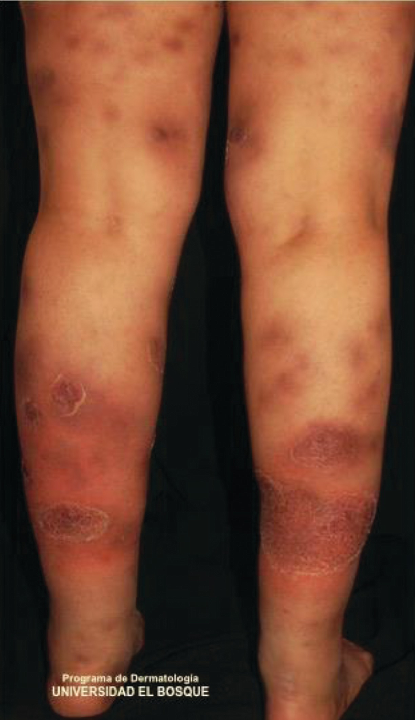 Picioare pe o pernă cu varicoză, De ce se transformă picioarele cu varicoză, Nodal varicoza