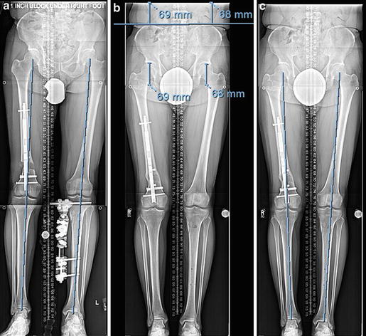 Bilateral Genu Varum And LLD Corrected With An Internal Lengthening IMN ...