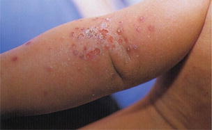 Viral Infections Springerlink