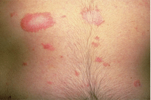 Pityriasis Rosea | SpringerLink