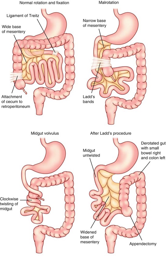 Malrotation | SpringerLink diagram of volvulus 