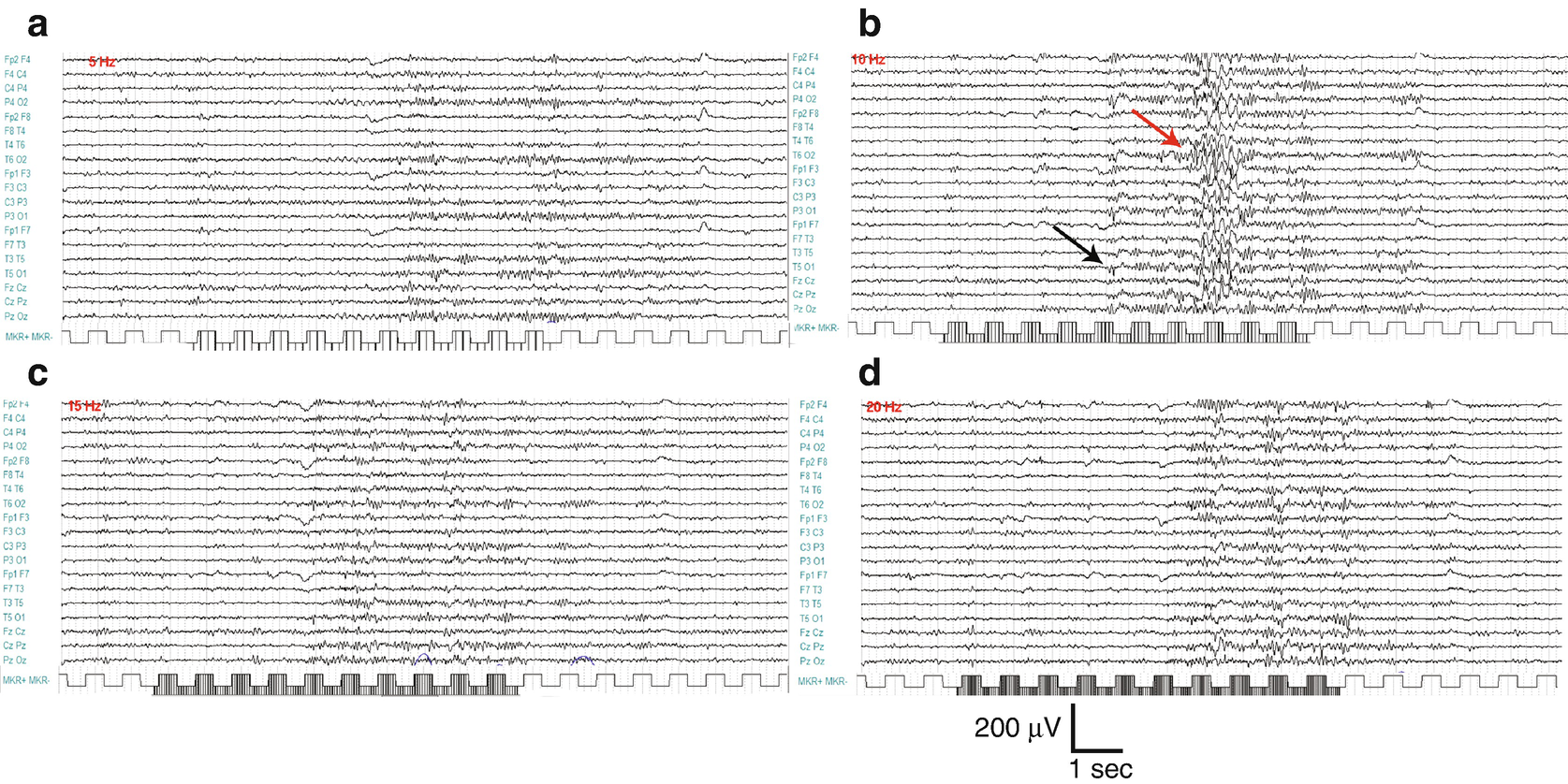 How To Interpret Photoparoxysmal Eeg Results Springerlink