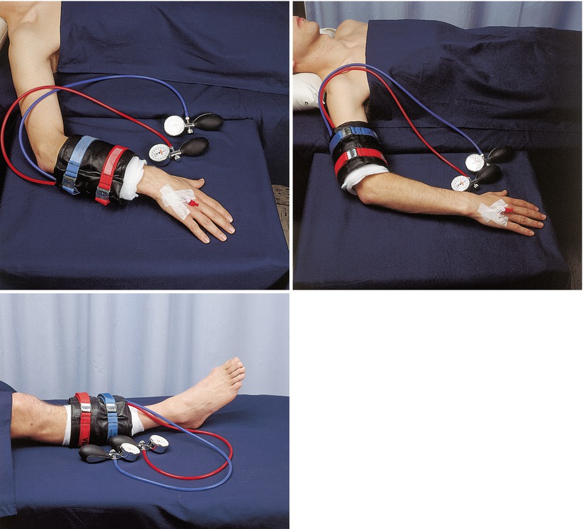 Intravenous Regional Anesthesia (IVRA) SpringerLink